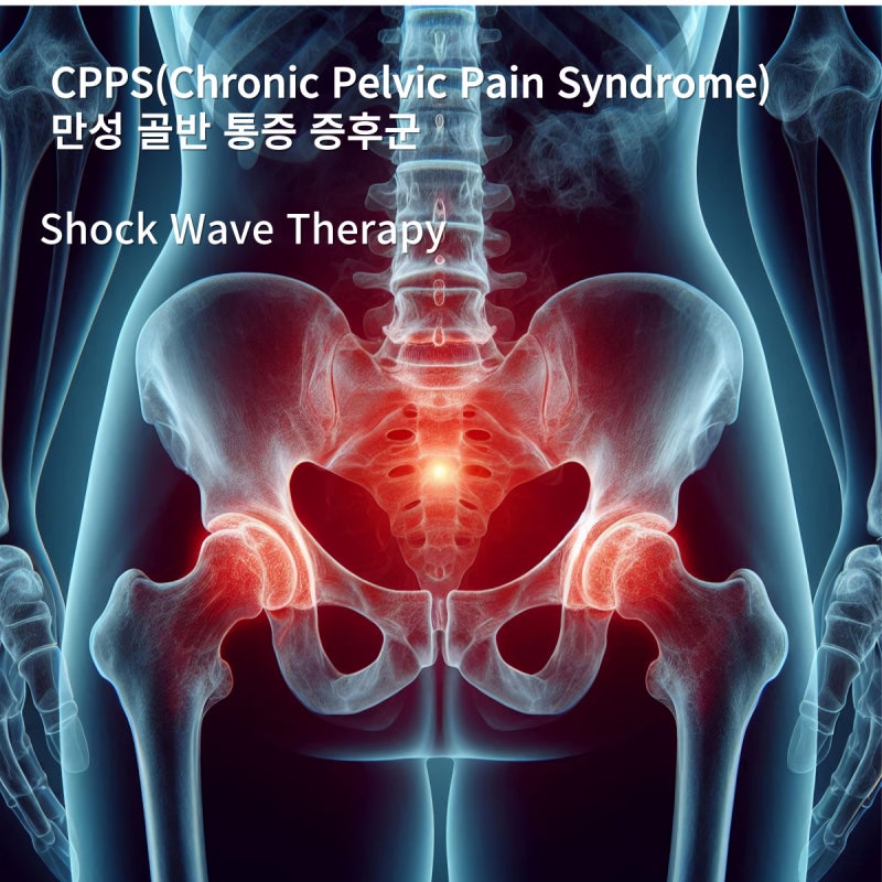 CPPS(만성골반통증증후군)과 Shock wave therapy (체외충격파치료)에 대하여