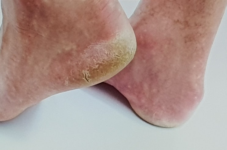  발톱 발바닥 무좀 증상 7가지는? 전염 및 재발 없는 치료 방법