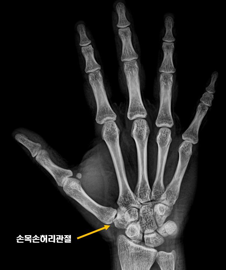  광주 서구 정형외과, 엄지손가락 아래 통증 사례
