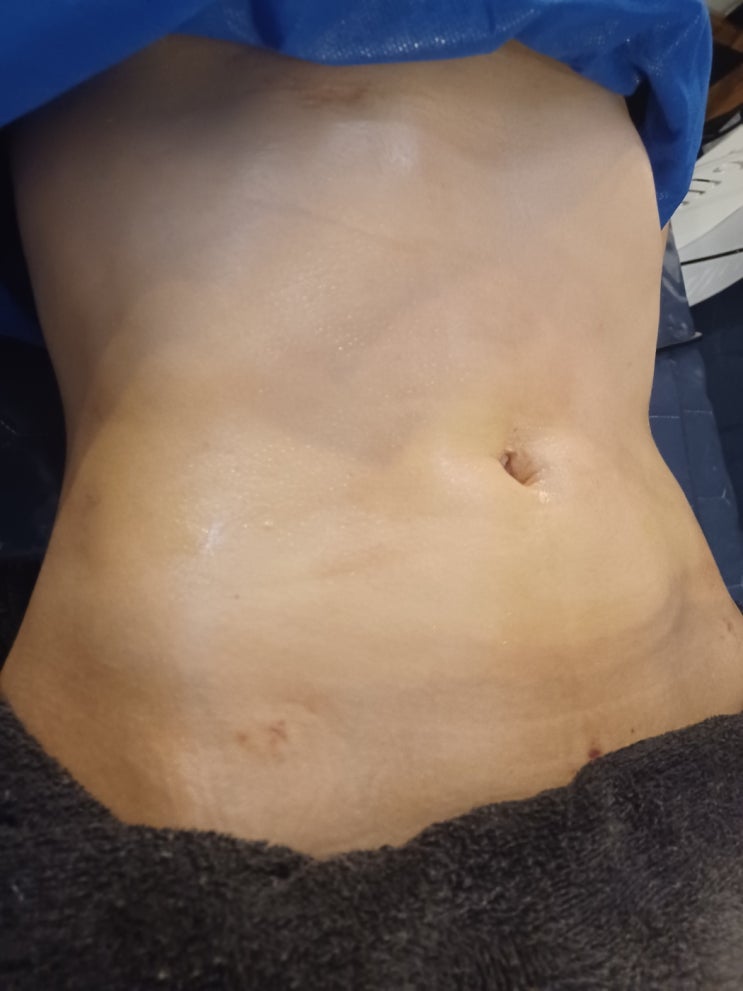  복부 지방흡입 부작용 줄이려면 이것만 기억하세요!