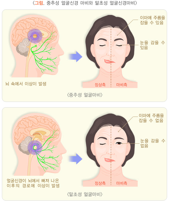 부산 안면마비 구안와사 치료 해운대한의원 365동백한의원