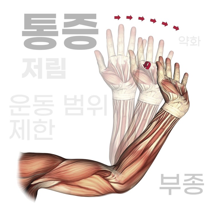  활기찬정형외과, 전문의가 말하는 손목터널증후군 예방