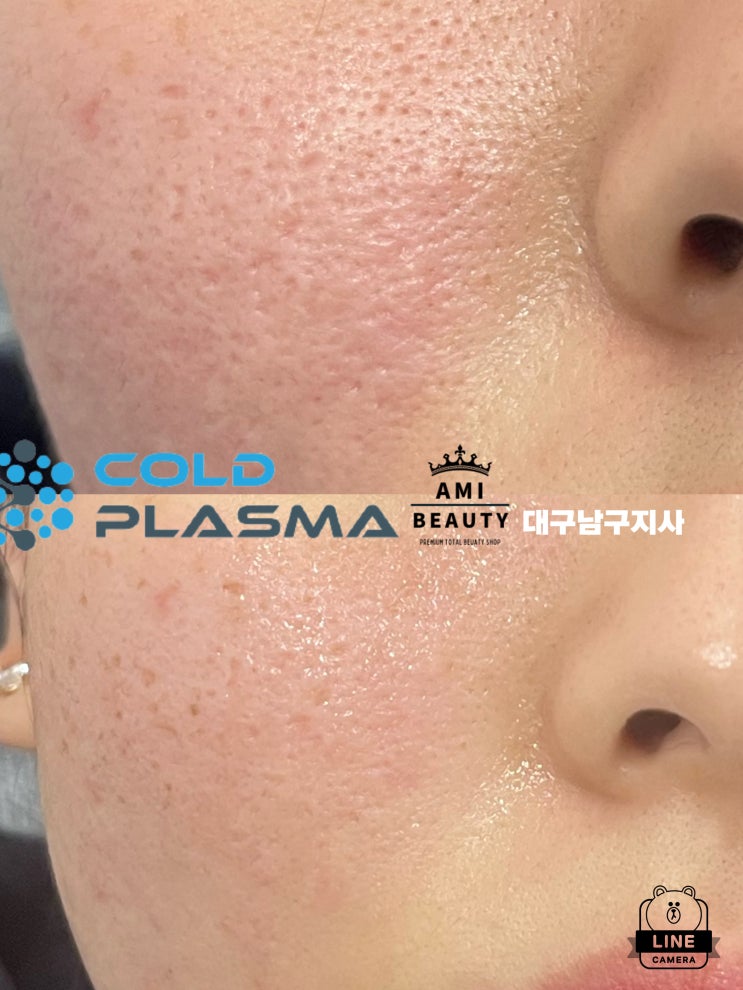  대구 아미뷰티, 플라즈마 피부관리로 여드름흉터를 극복하라!