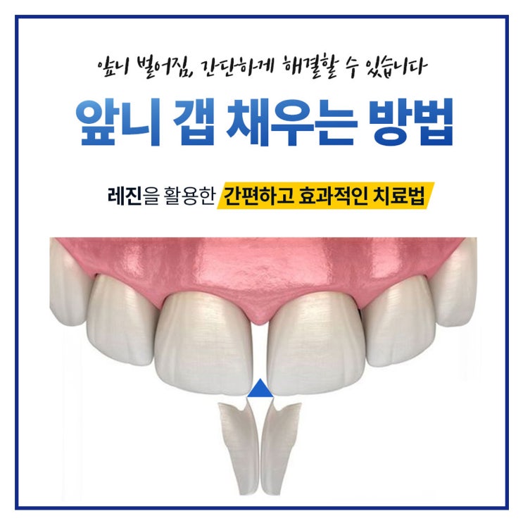  성남 앞니벌어짐 앞니깨짐 레진 성남치과 당일치료법
