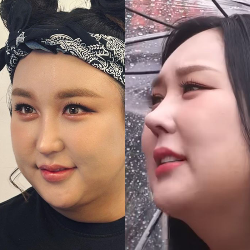 풍자 코성형 변천사 직선코에서 자려한 직반라인 +코수술 부작용