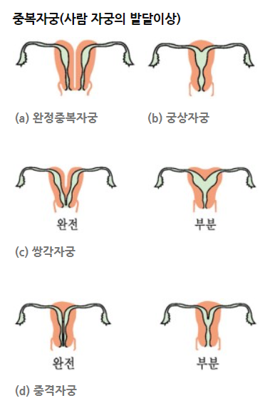  선천성 자궁기형 중격자궁 수술 후기 1편