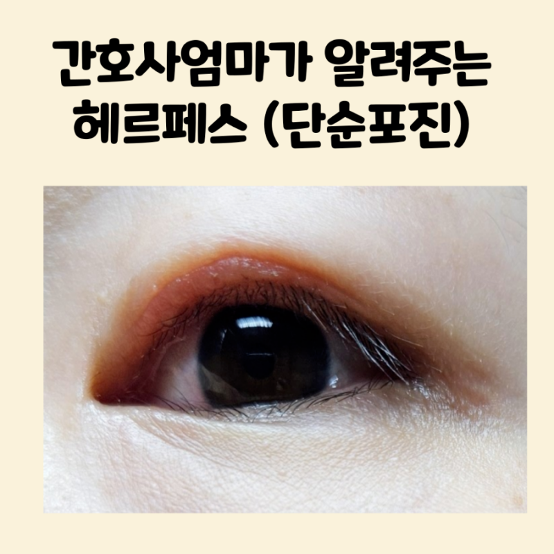 눈 물집 헤르페스 포진 통증 충혈