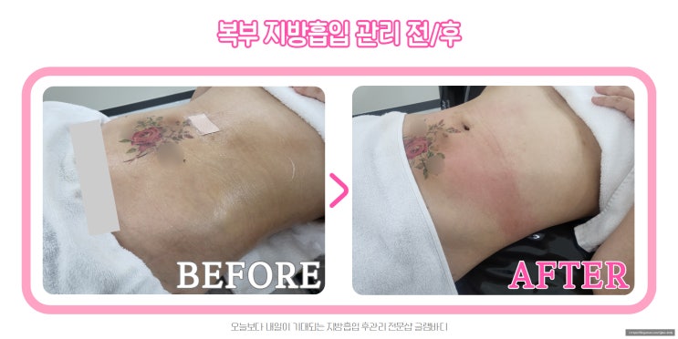  복부 지방흡입 후 바이오본드 뭉침으로 인한 관리 후기