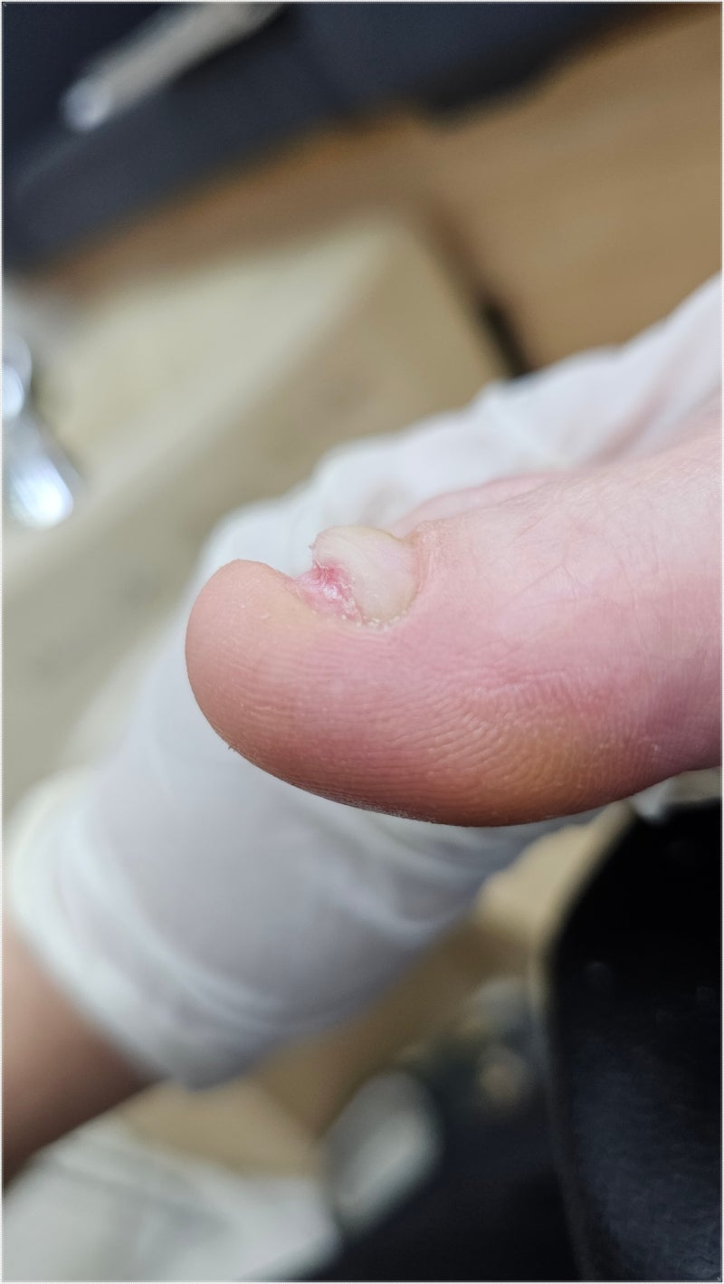 마산무좀발톱 믿기지 않는 관리 효과 네일팝 페디크루 내성발톱 무좀 문제성발 네일