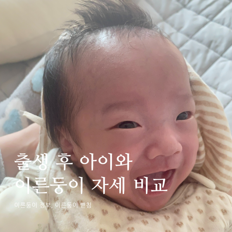 출생 후 아이와 이른둥이의 자세 비교 이른둥이자세 출생 후 아이와 이른둥이의 자세 비교 이른둥이자세