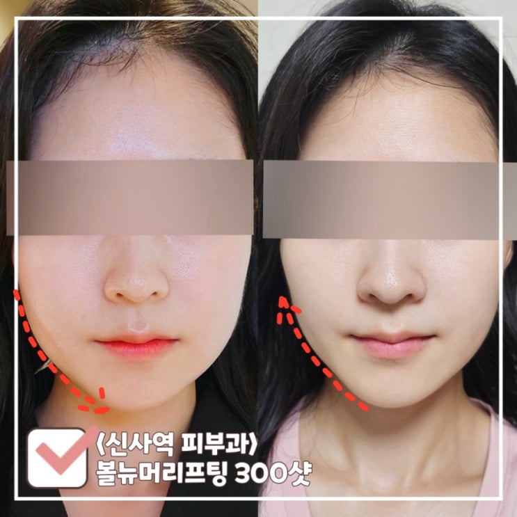  신사 피부과 잃어버린 라인과 탄력을 되찾아 주는 볼뉴머 리프팅 300샷 후기