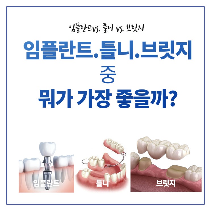  성남 임플란트 틀니 브릿지 놓고 뭘해야할까?
