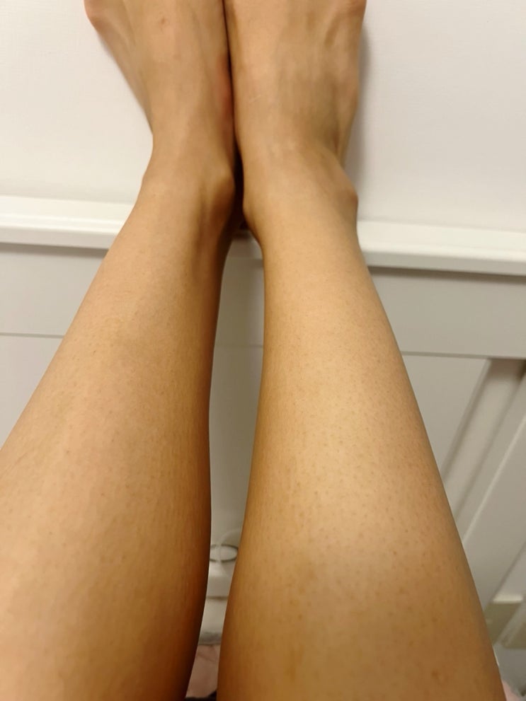  강남 레이저제모 종아리 다리제모 2회차 솔직후기