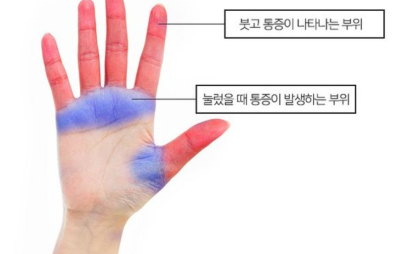 골프 방아쇠수지 증후군 완치 가능할까?