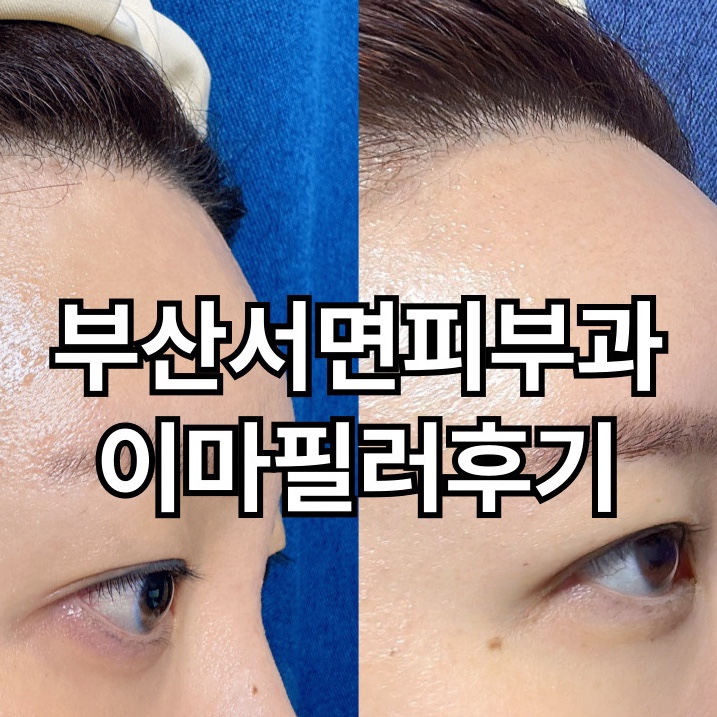  부산서면피부과 [이마필러] 국산 유스필 후기