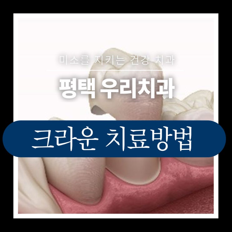  평택 근처 크라운 충치 치료 후 치과 치료법