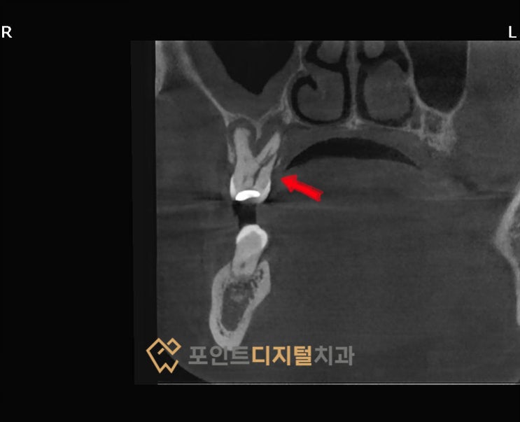  [탕정치과] 디지털로 어려운 케이스 쉽게 하기, 치근파절 케이스(덴티움) / 천안 아산