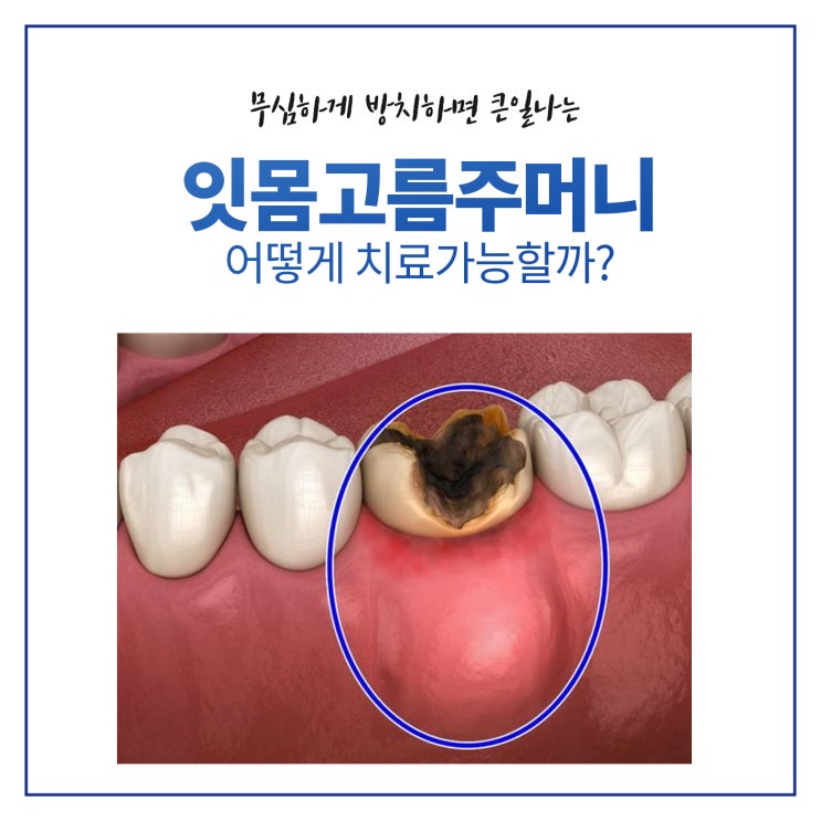  성남 잇몸고름주머니 치과 치료ㅣ 이훈재 원장님의 예방 전략
