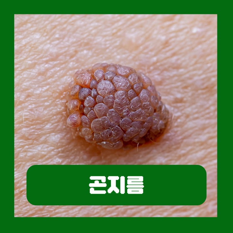  곤지름인가요 남자 생식기 뾰루지 원인 초기증상 검사 치료법