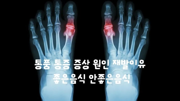  통풍 증상 통증 원인 재발이유 좋은음식 안좋은음식