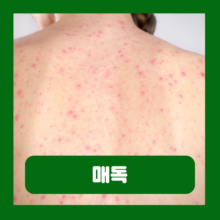  매독이란 걸리는 이유 환자 초기 증세 헌혈 전염 임신 자연치유