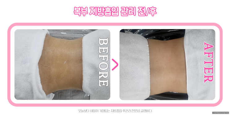  복부 지방흡입 고주파관리 4회차 후기