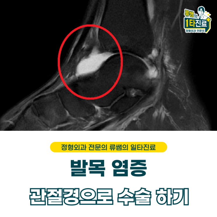  발목 염증 수술 치료와 항생제 치료  (의사작성)