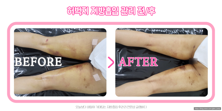  허벅지 지방흡입 후 멍 붓기 통증이 고민이시라면?