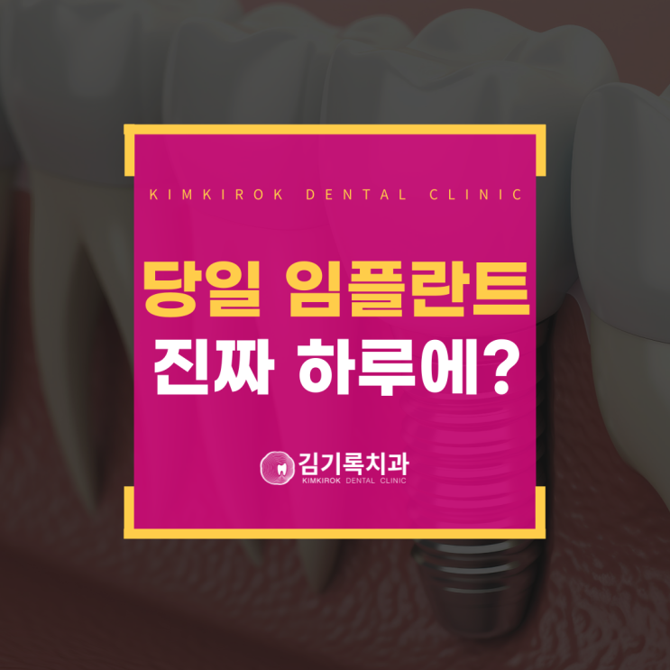 영동구청 당일 임플란트, 진짜 하루 만에 가능할까?