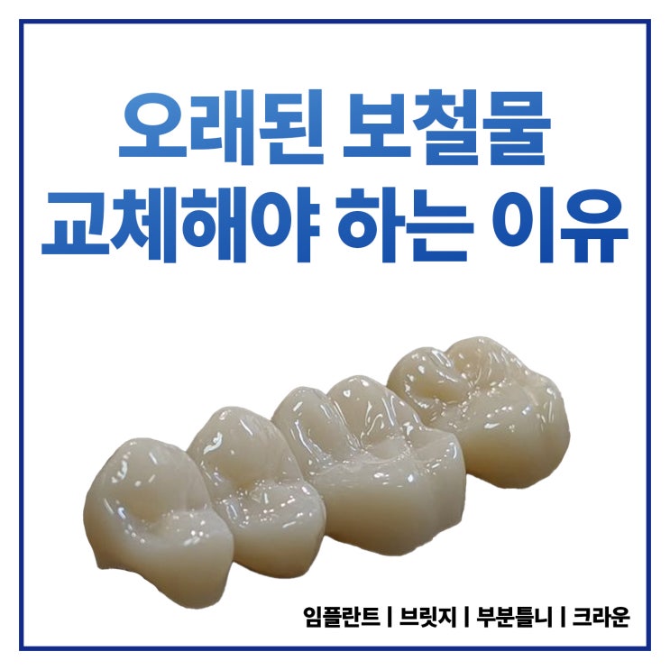  성남치과 오래된 보철물 교체해야 하는 이유, 치아 보철물 수명