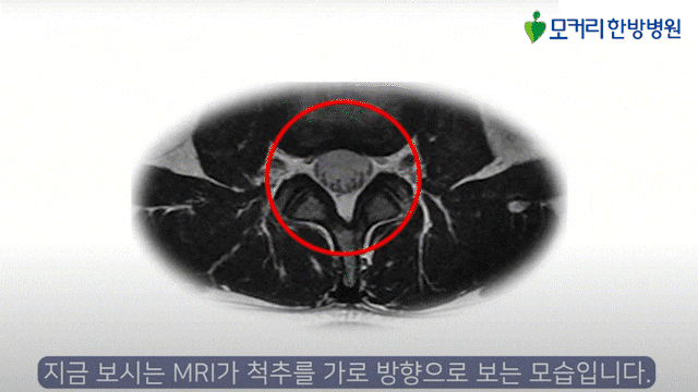 척추전방전위증 비수술로 치료 의정부한방병원 모커리한방병원