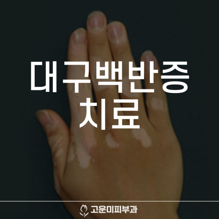  대구백반증치료 피부에 생기는 얼룩덜룩한 하얀 반점 꾸준한 치료가 필요합니다