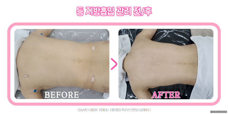  등 지방흡입 후관리 5회차 케어 전후!