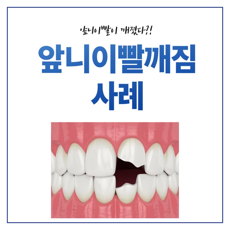  성남 앞니빨깨짐 이빨깨짐 신흥역 치과 치료 사례