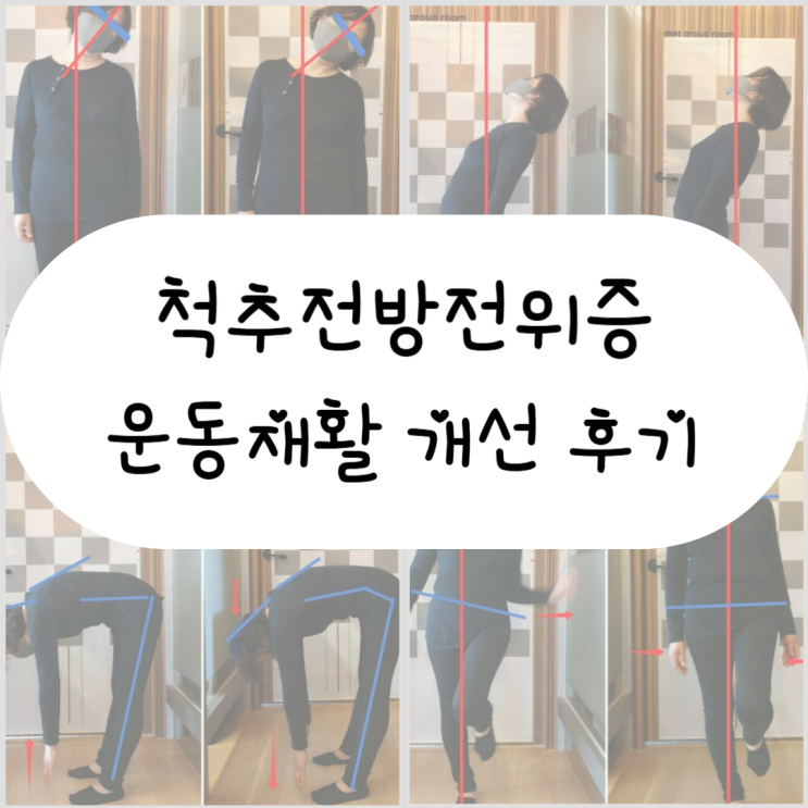  [부산 동래 필라테스] 부산 척추전방전위증 운동 재활 개선 후기
