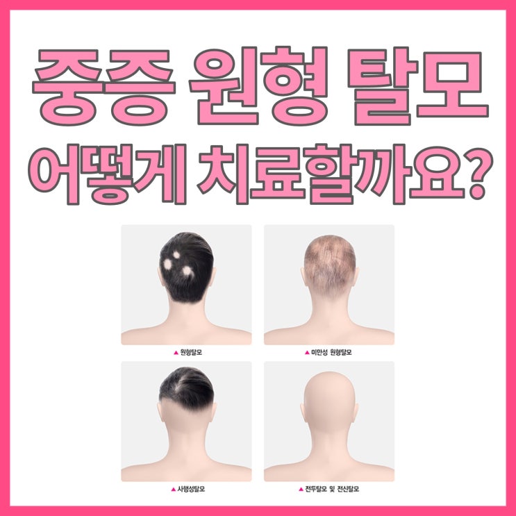  머리카락에 갑자기 큰 구멍이? 중증 원형탈모까지 진행됐다면 어떻게 해야 할까요?