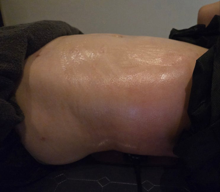  복부 지방흡입 후관리 체형 파악과 관리가 중요한 이유