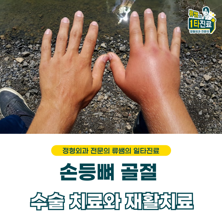  손등뼈 골절 수술적 치료와 재활 치료 기간 (의사작성)