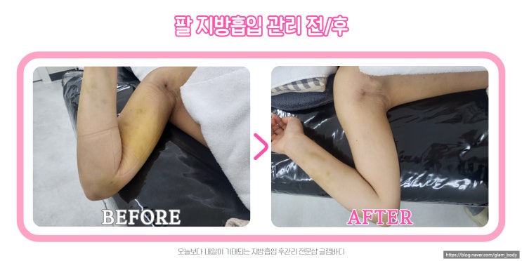  팔지방흡입 붓기, 멍 잘 빼는 맛집