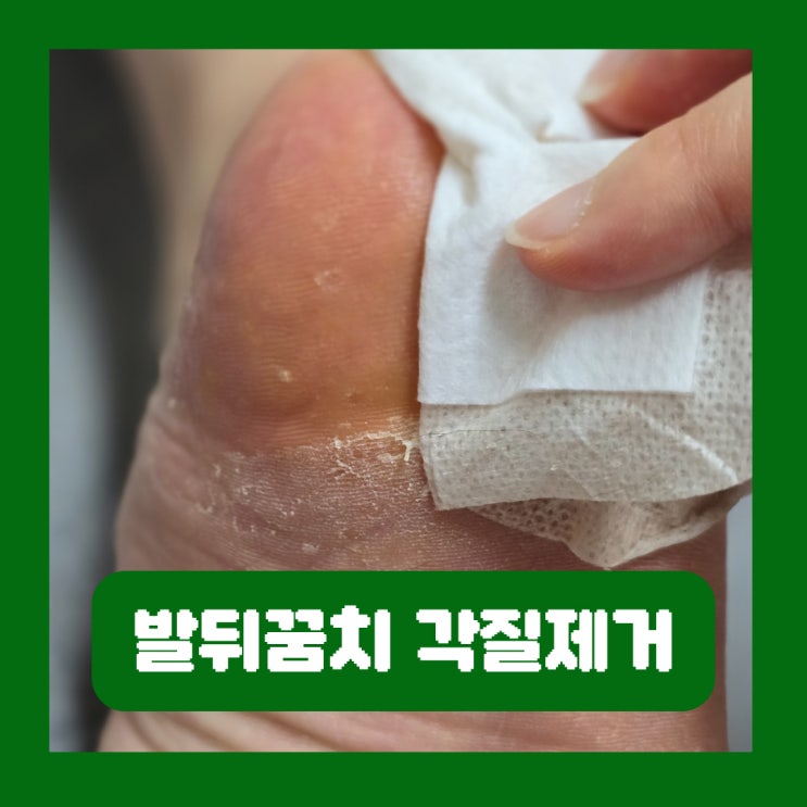  뒷꿈치 각질제거 발뒤꿈치 갈라짐 관리 간편한 발팩 프레티
