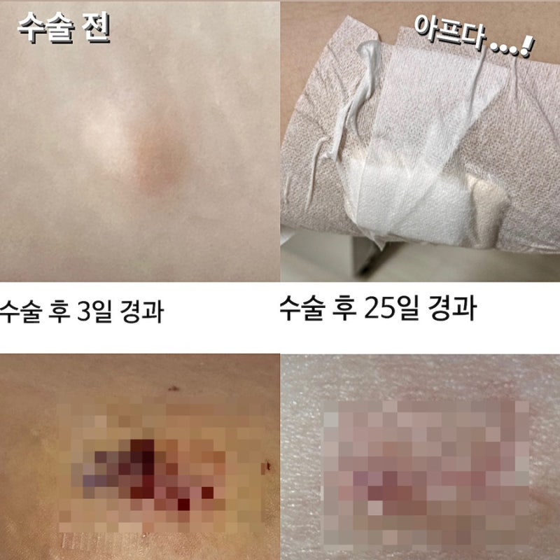 지방종 제거 후기 , 피지낭종 제거 후기 (자세한 수술과정, 비용, 회복과정 사진있음)