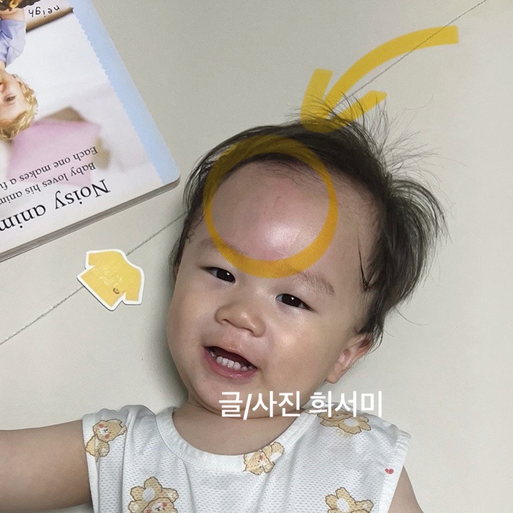  아기 타박상 멍들었을때 다쳤을때 병원어디로 내상은 내과 외상은 외과 성형외과