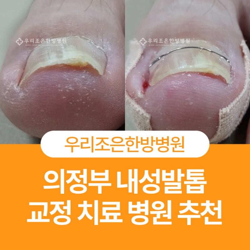 의정부 내성발톱 교정 치료 추천 민락동 우리조은한방병원