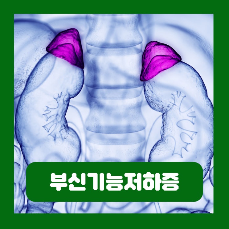  부신 종양수술 기능 저하증 원인 쉬어도 피곤한 증상 자가진단