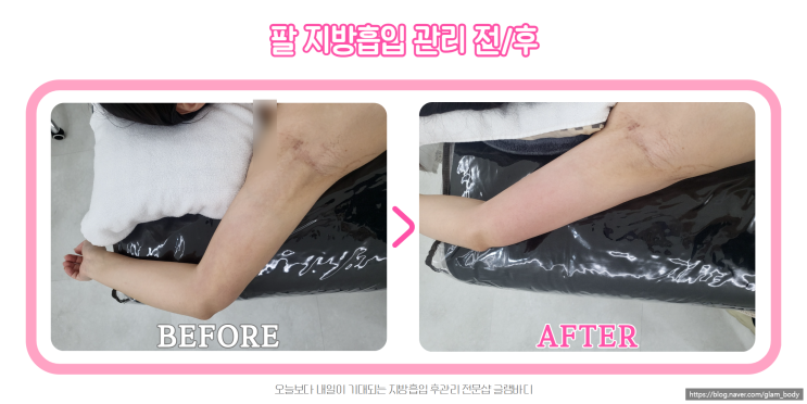  팔 지방흡입 후 부유방, 팔뚝 바이오본드 3회차 관리 전후