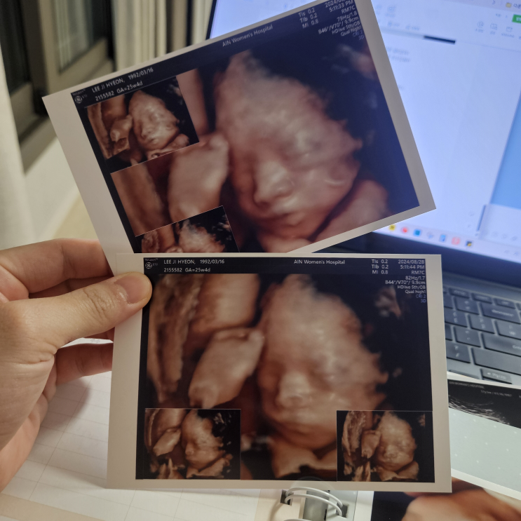  [임신 24주~28주] 임신성 당뇨검사와 입체초음파