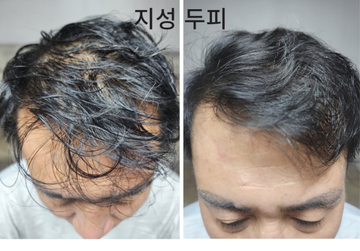  지성두피샴푸 추천 두피 트러블 유분기 케어
