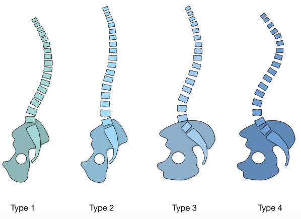  요추 전만(lordosis) 자세의 원인과 전만을 만드는 근육!!