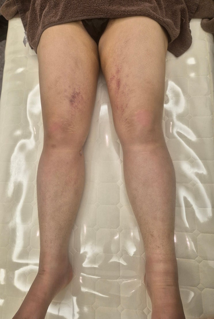  허벅지 지방흡입 후 다리가 안 굽혀져요 해결 방법
