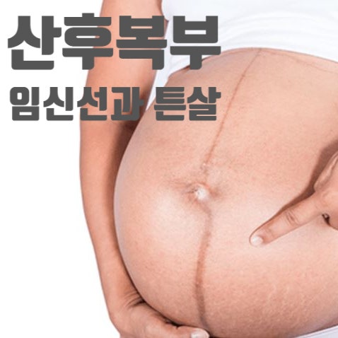  산후복부의 피부변화와 관리 (1) 복부흑선과 튼살(임신선조)